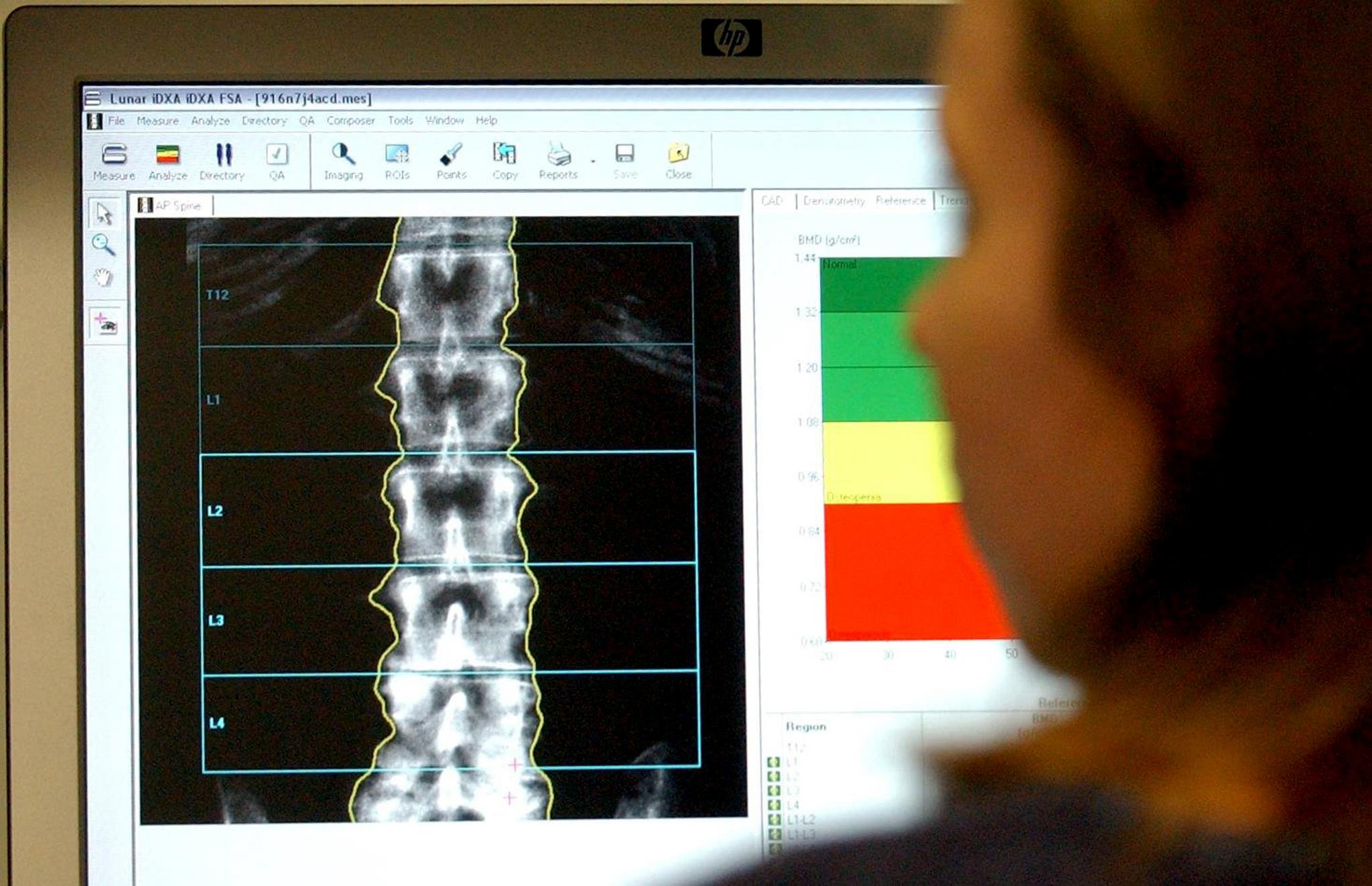 One in seven people in Woking suffer joint, bone and muscle conditions