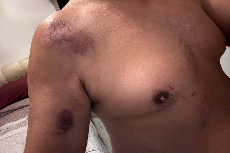 A man that has been injured by what he claims was a leopard. A man claims he was left bleeding and with claw marks all over his body - after an encounter with a LEOPARD in Surrey. The 69-year-old, who did not want to be name says was walking in the Surrey Hills last Sunday (August 31) when he spotted a deer through a hedge. He stopped to take photos and all of a sudden he heard a "screech" as a light-coloured animal "with dark spots" leapt onto the deer, sending the pair tumbling towards him. In the chaos, the deer managed to escape and flee into the woods - but the big cat landed on top of the walker and started clawing at him.