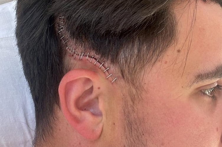 Joshua Baines' surgery scar. A dad of three, was told he was just dehydrated, before being diagnosed with a terminal brain tumour. Josuha Baines, 34, was found lying unconscious and covered in blood by his daughter, then 4, in 2021, following a seizure. The vicar, from Esher, Surrey, was rushed to hospital, but doctors told him the seizure was just due to dehydration.A few weeks later, Josh had another seizure, and he was eventually diagnosed with an aggressive terminal brain tumour in 2022. 
